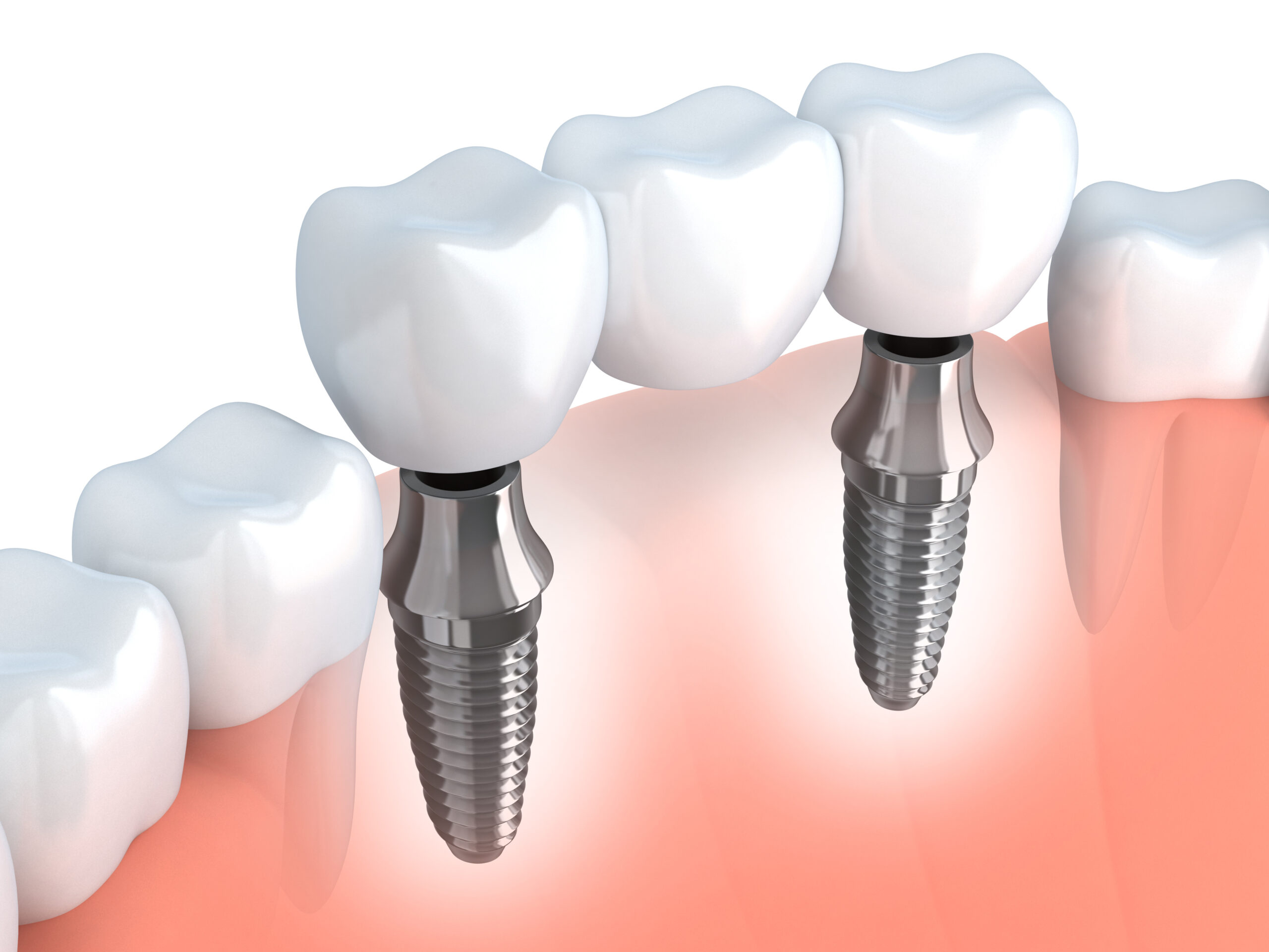 All on 4 Dental Implants 